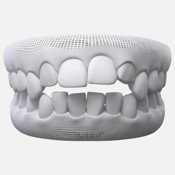 Open bite