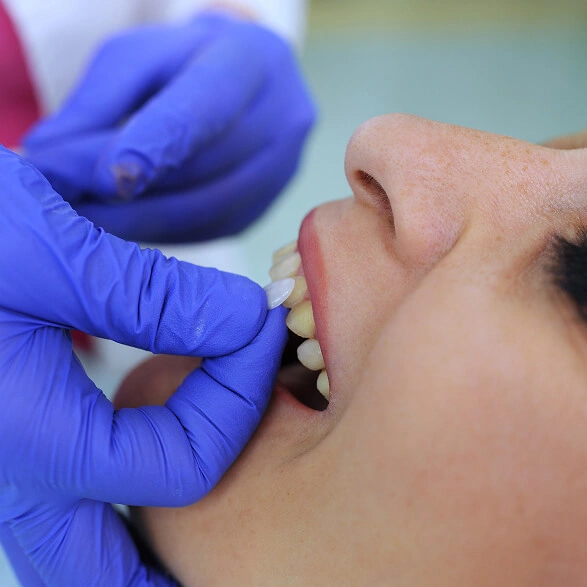 Veneers