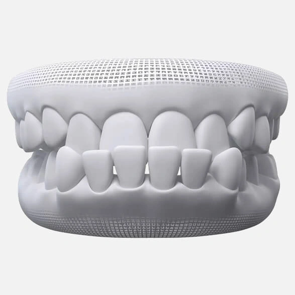 Underbite